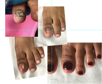 Toeflex Hybrid Gel for Toe nail reconstruction,