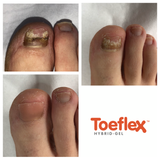 Toeflex Brush and Spatula for Toe nail reconstruction